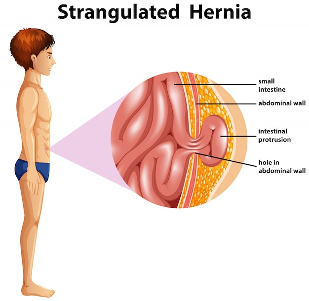 Anatomia Przepukliny Uduszonej