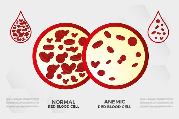 Anemia żelaza Czerwonych Krwinek Medycznych Ilustracji Wektorowych Medycznych.