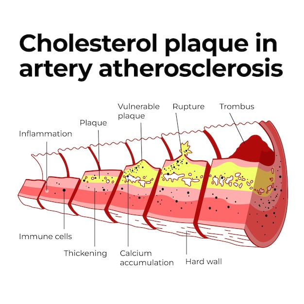 Plik wektorowy blaszka cholesterolowa w miażdżycy tętnic