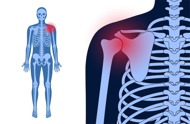 Ból Barku Lub łopatki. Szkielet X Ray Sylwetka Człowieka. Stawy I Chrząstki W Ludzkim Ciele