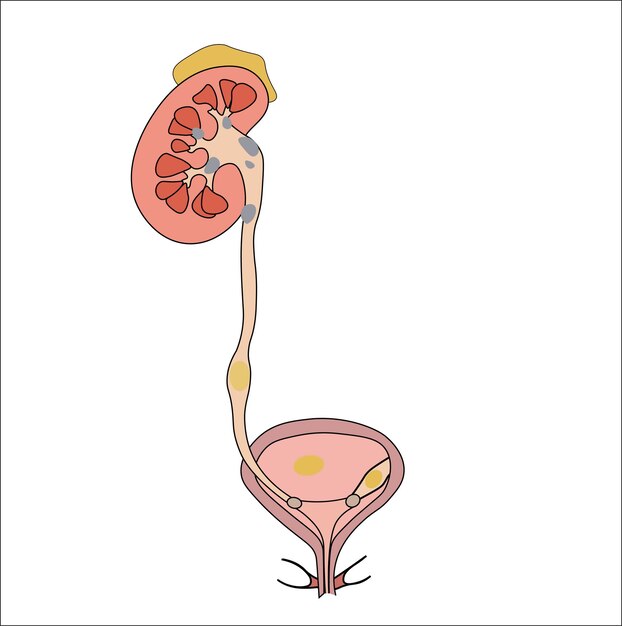 Plik wektorowy calculi renal patho