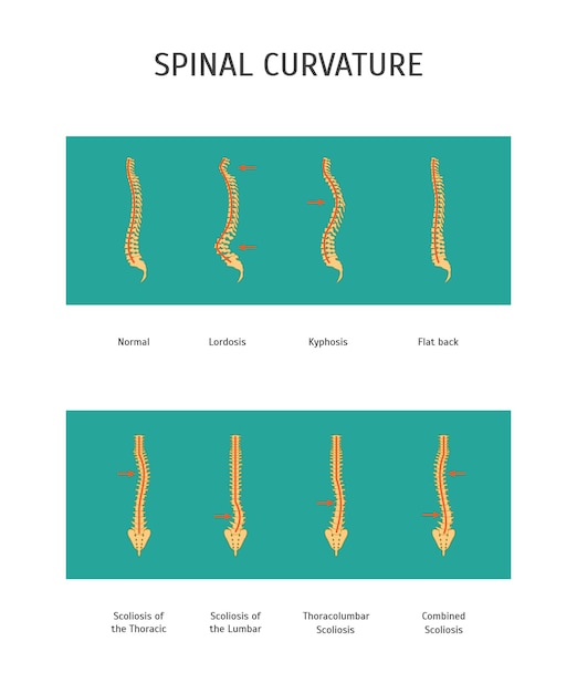 Plik wektorowy cartoon scoliosis set card poster spine human health care concept element flat design style