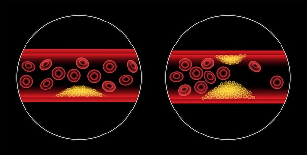 Plik wektorowy cholesterol a miażdżyca