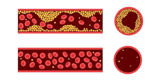 Plik wektorowy cholesterol a miażdżyca