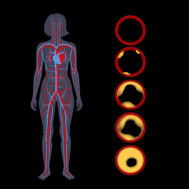 Cholesterol A Miażdżyca