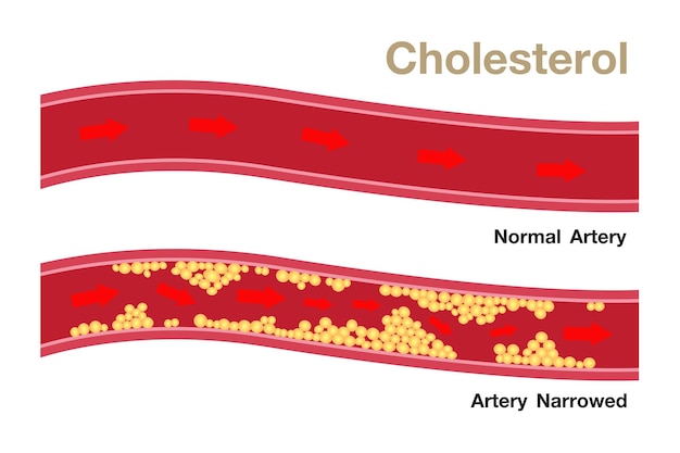 Cholesterol w projektowaniu wektorów ryzyka dla zdrowia tętnic