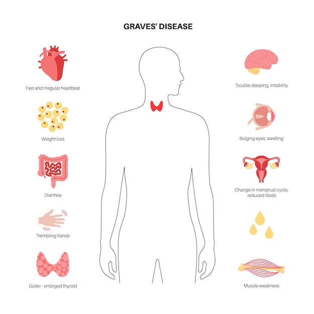 Plik wektorowy choroba gravesa-basedowa nadczynność tarczycy i zaburzenia układu odpornościowego nadczynność tarczycy