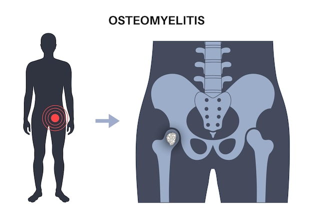 Plik wektorowy choroba zapalenia kości i szpiku zakażony ból biodra i pokrywające się zaczerwienienie zakażenie rozprzestrzenia się przez krwioobieg do kości udowej bakteria staphylococcus aureus w ludzkim ciele ilustracja wektorowa