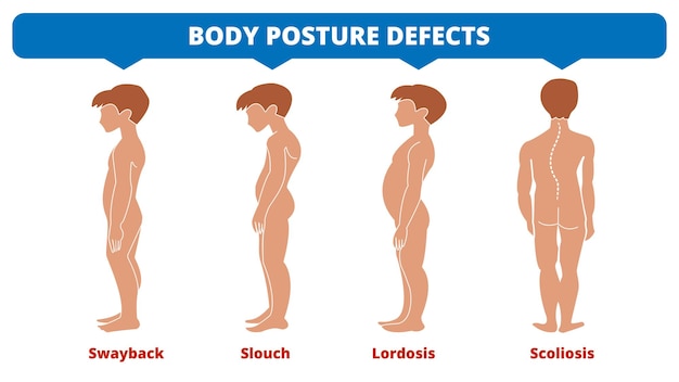 Choroby Kręgosłupa. Skolioza, Lordoza, Kołysanie Się, Garbić. Wady Postawy Ciała. Rodzaje Deformacji Kręgosłupa. Infografika Choroby Medycznej. Objaw Diagnostyczny. Sylwetka Chłopców. Ilustracja Wektorowa.