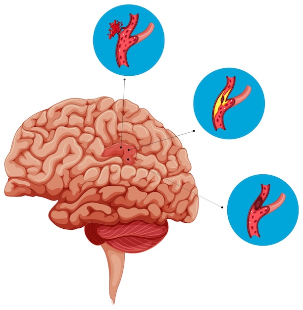 Plik wektorowy diagram przedstawiający problemy z mózgiem