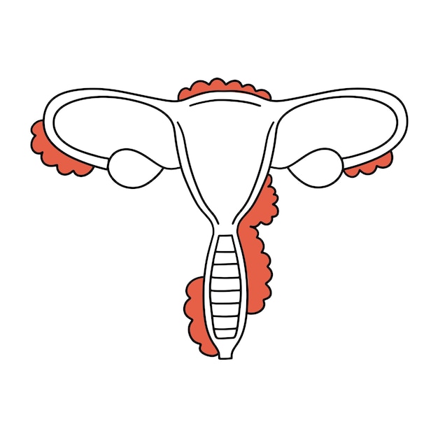 Plik wektorowy endometrioza kobiecej macicy problemy zdrowotne kobiet ilustracja wektorowa w stylu line art