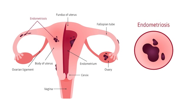 Endometrioza Macicy Obejmuje Jajniki, Jajowody I Szyjkę Macicy