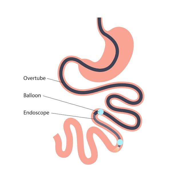 Enteroskopia Dwubalonowa Zabieg Minimalnie Inwazyjny Wizualizacja Jelita Cienkiego Biopsja Usunięcie Polipów Terapia Krwawienia Umieszczenie Stentu W Przewodzie Pokarmowym Ilustracja Wektorowa