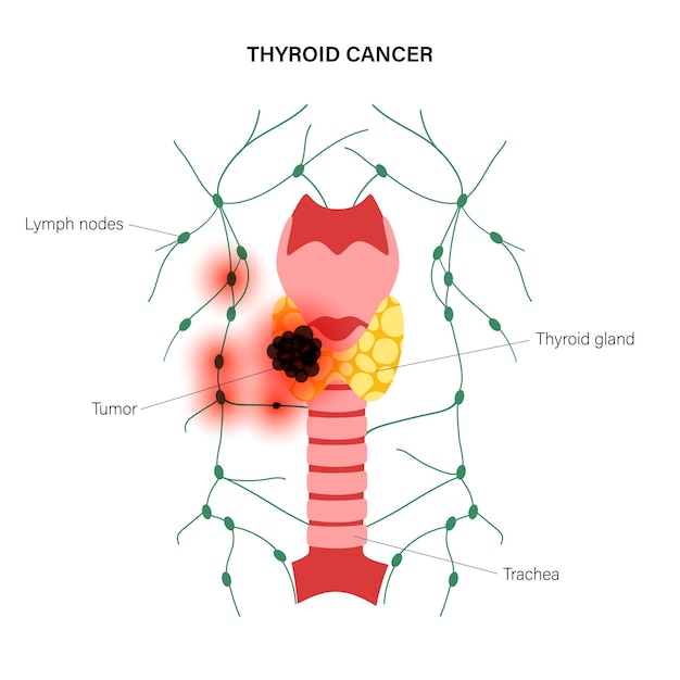 Plik wektorowy etapy raka tarczycy