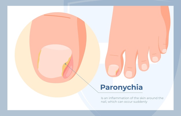 Plik wektorowy gnicie paznokci, wrastające paznokcie, choroby palców stóp. leczenie i pielęgnacja problematycznych paznokci
