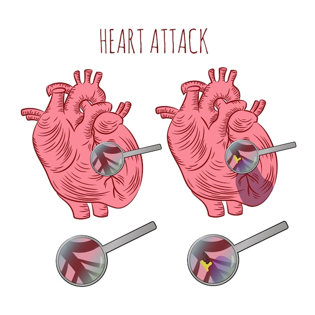 Heart Attack Atherosclerosis Medicine Education