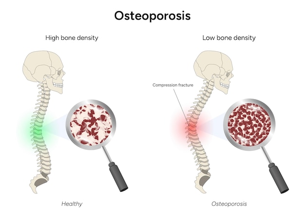 Plik wektorowy ilustracja medyczna osteoporozy i zdrowego kręgosłupa w wektorze