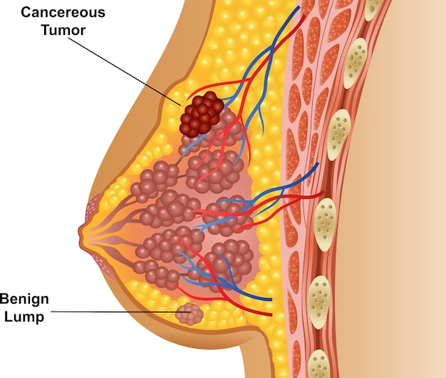 Ilustracja Nowotworowego Raka Piersi