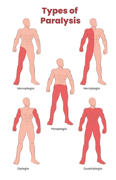 Plik wektorowy ilustracja rodzajów paraliżu