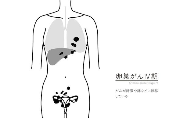 Plik wektorowy ilustracja schematyczna anatomii macicy i jajników w stadium iv raka jajnika