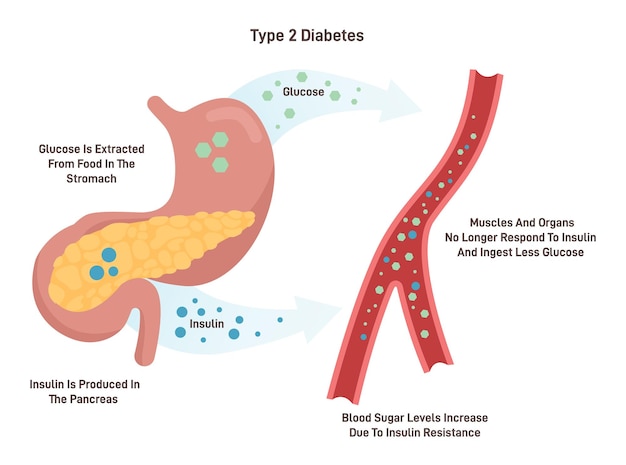 Plik wektorowy ilustracja wektora medycznego cukrzycy typu 2 z opisem w języku angielskim