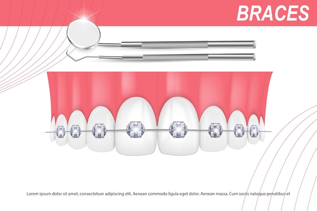 Ilustracja Wektorowa 3d Realistyczne Zęby Z Aparatem Ortodontycznym Górna I Dolna Szczęka Wyrównanie Zgryzu Zębów Uzębienie Za Pomocą Aparatu Ortodontycznego