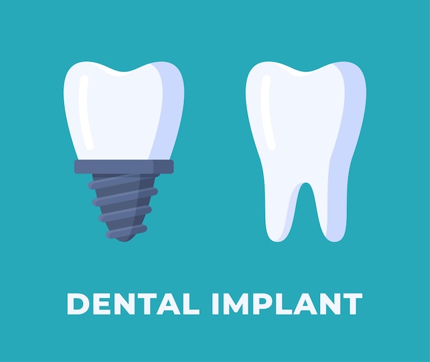 Ilustracja Wektorowa Implantu Dentystycznego Izolowana Na Niebieskim Tle Implantu Dentystycznego