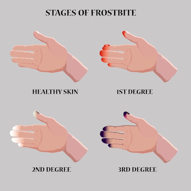 Ilustracja Wektorowa Medyczna Etapy Odmrożenia Niebieskie I Czerwone Odmrożone Palce Etapy Hipotermii W Zimnych Porach Roku