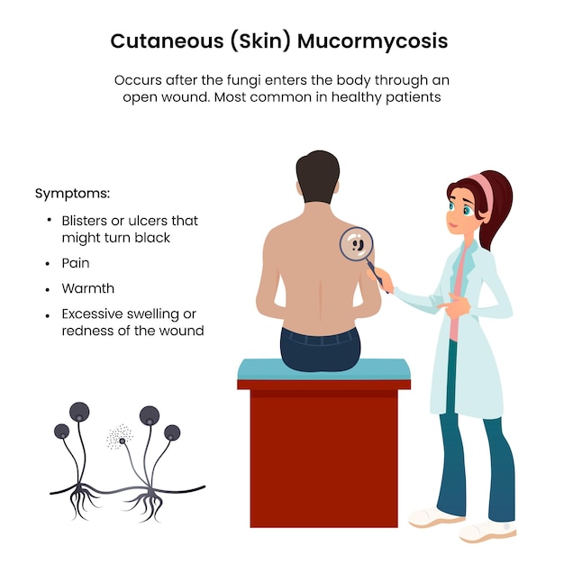 Plik wektorowy ilustracja wektorowa mucormycosis skóry