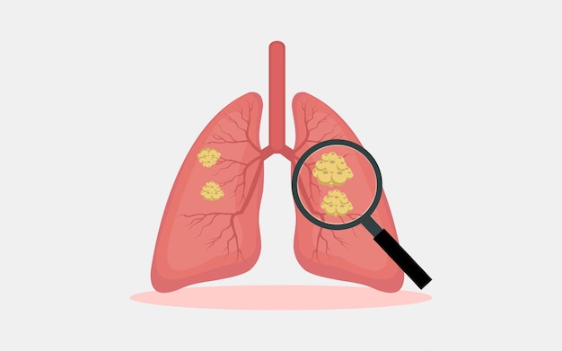 Ilustracja Wektorowa Złośliwego Guza Raka Płuc