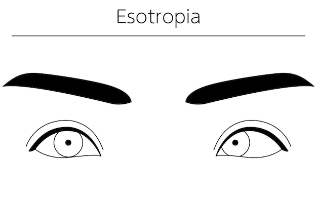 Plik wektorowy ilustracje medyczne schematyczne rysunki linii chorób oczu zez i esotropia