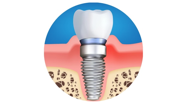 Plik wektorowy implant dentystyczny realistyczna ilustracja wektorowa