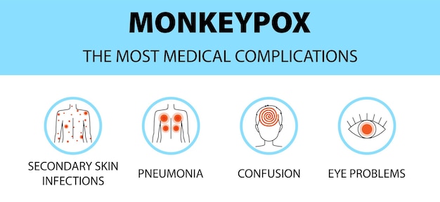 Infografika Ikon Wirusa Ospy Małpiej Najbardziej Komplikacje Medyczne Nowe Przypadki Epidemii W Europie I Usa