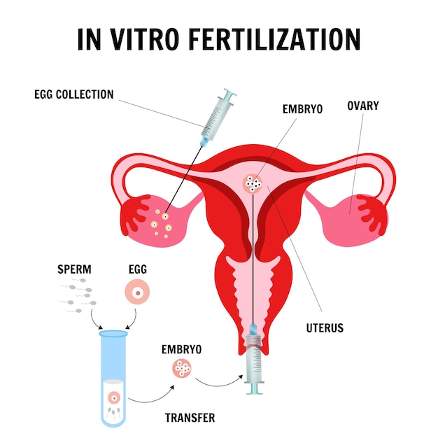 Plik wektorowy infografika medyczna składu zapłodnienia in vitro w wektorze