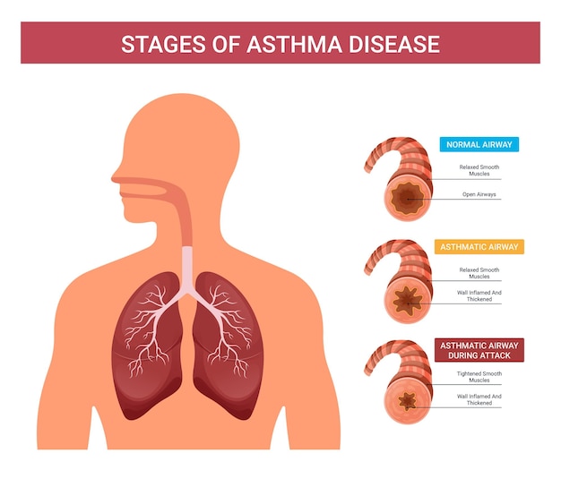 Infografiki Astmy, Etapy Wektorowe Astmy U Ludzi