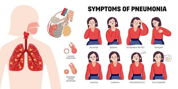 Plik wektorowy infografiki ludzkiego zapalenia płuc z postaciami kobiecymi reprezentującymi typowe objawy i ikony komórek bakteryjnych z ilustracją wektorową płuc