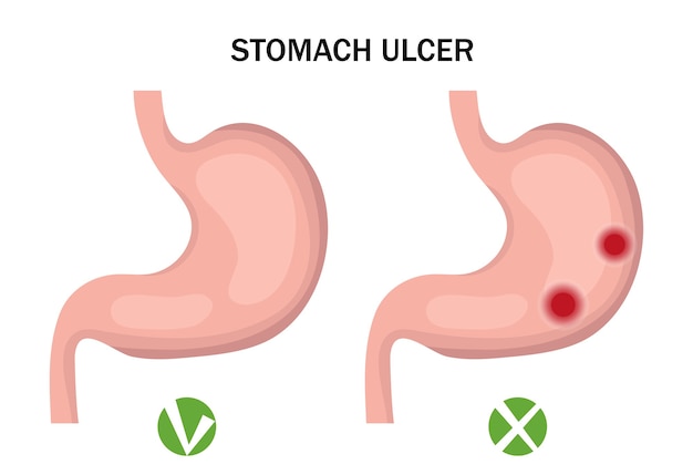 Infografiki Wrzodu żołądka I Zdrowego żołądka. Koncepcja Medycyny.