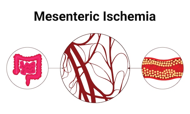 Plik wektorowy ischemia międzyjelitowa