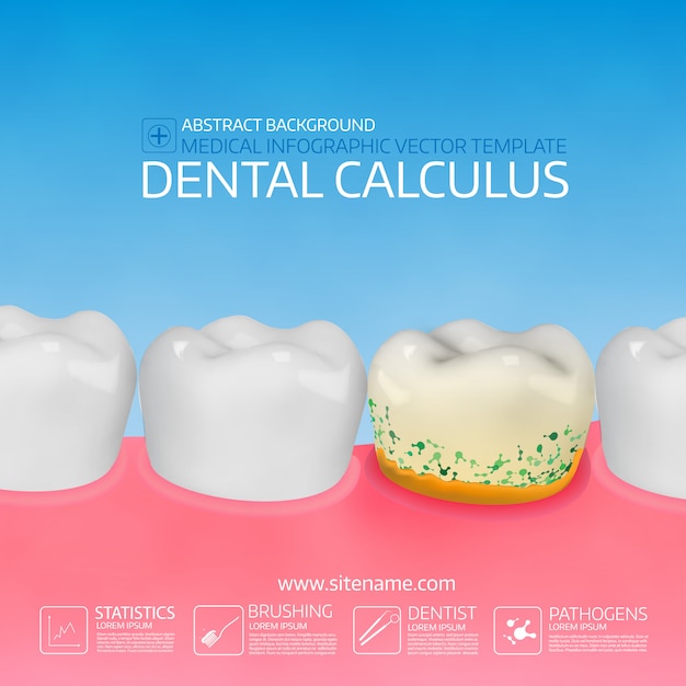 Kamień Dentystyczny Z Bakteriami.