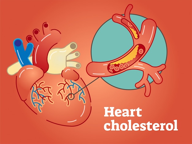 Koncepcja Cholesterolu Serca