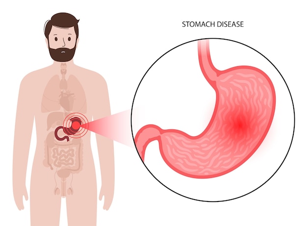 Plik wektorowy koncepcja choroby żołądka