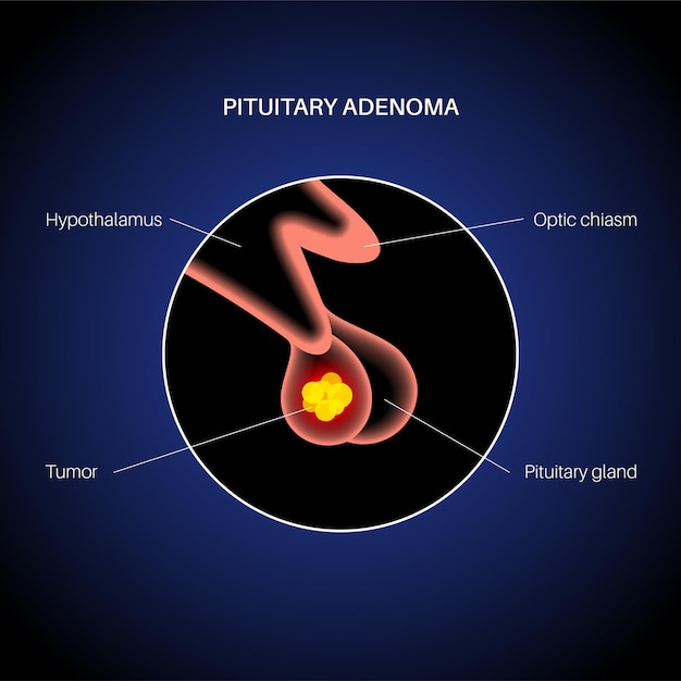 Plik wektorowy koncepcja gruczolaka przysadki. guz w ludzkim mózgu. choroba lub rak głowy. problem podwzgórza. anatomia tylnej i przedniej przysadki mózgowej. ilustracja wektorowa płaskie medyczne dla kliniki