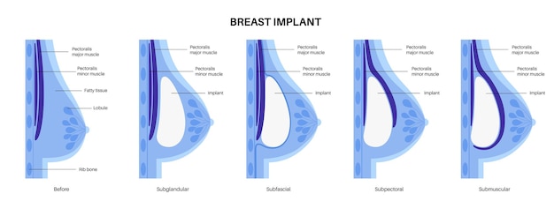 Koncepcja Implantu Piersi