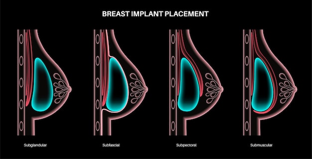 Koncepcja Implantu Piersi