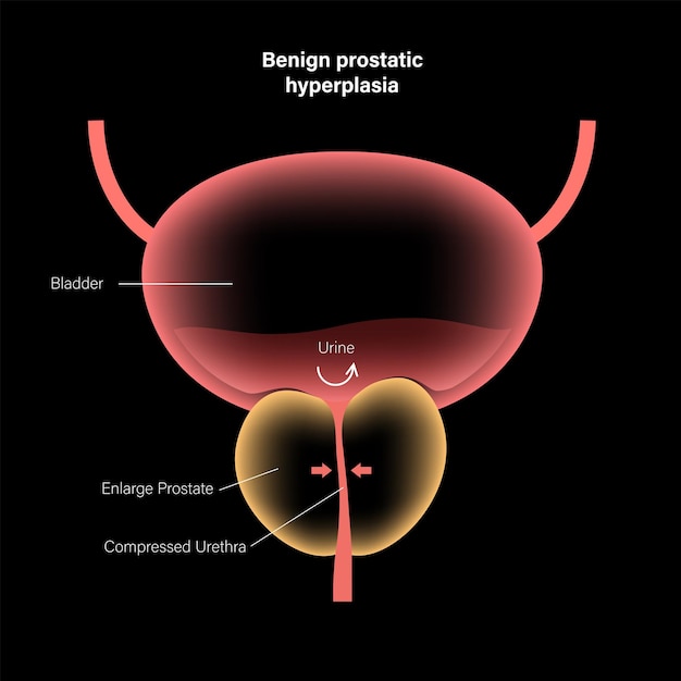 Koncepcja informacji BPH