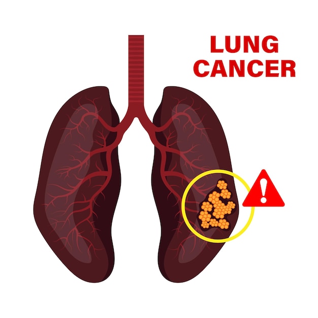 Koncepcja Raka Płuc Wektor Ilustracji Komórek Nowotworowych Zdrowia