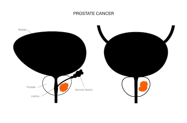 Plik wektorowy koncepcja raka prostaty