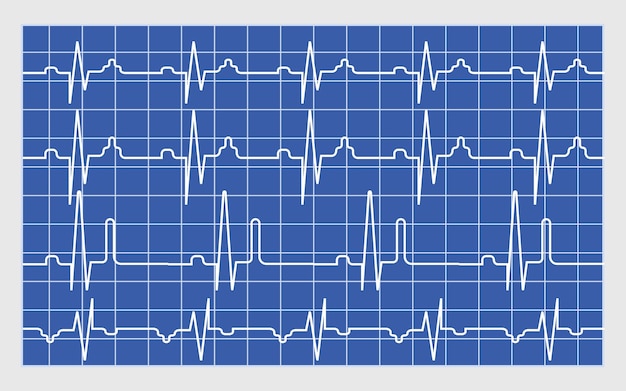 Koncepcja Wektora Wyniku Skanowania Elektrokardiogramu Monitor Ekg Do Awaryjnego Testu Kardiologicznego Ilustracja Bicie Serca