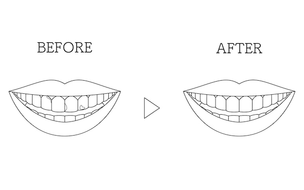 Plik wektorowy kosmetyczna stomatologia bezpośrednia przed i po odbarwieniu zębów