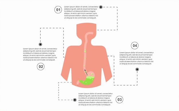 Kreatywny Szablon Infografiki Dla Znaku Gerd Choroby żołądka Z 4 Opcjami